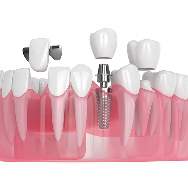 CROWNS-&-BRIDGES