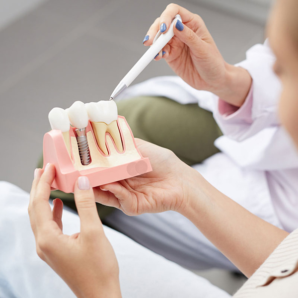 dental implant image