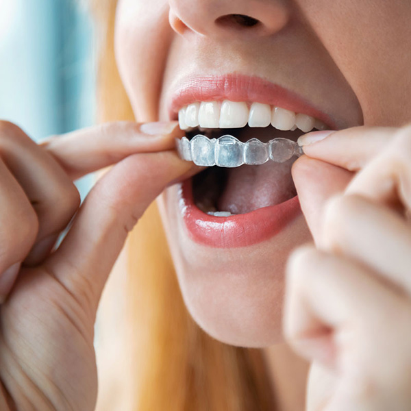 invisalign Clear Aligners Cambridge