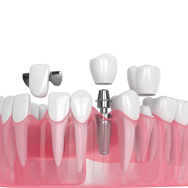 dental-restorations